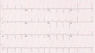 Atrial or ventricular ECGEKG [upl. by Ahsikel281]