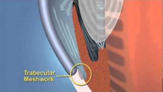 Closed Angle Glaucoma [upl. by Earazed]