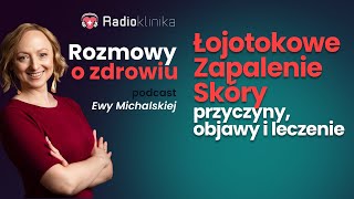 Łojotokowe zapalenie skóry  przyczyny objawy i leczenie [upl. by Tneicniv]