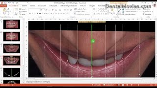 Digital Smile Design Christian Coachman amp Livio Yoshinaga PART 34 [upl. by Procter]