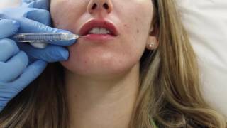 Juvederm lip filler injection by Dr Shaun Patel in Miami Florida [upl. by Aneekat]