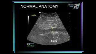 Abdominal aortic aneurysm ultrasound [upl. by Bradwell]