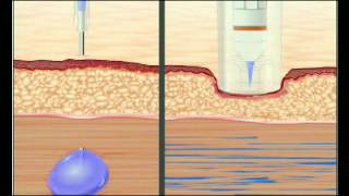 Needle VS Needle Free Injection [upl. by Hesky789]