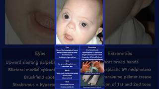 Down Syndrome Dysmorphic Features [upl. by Alwin]