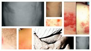 Other Symptoms Of Shingles Rash [upl. by Coletta]