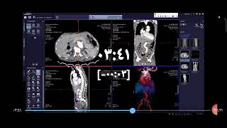 ct aortography ct siemens go now [upl. by Boyes]