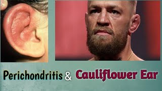 Perichondritis amp Cauliflower Ear  ENT Lecture [upl. by Tirrej]