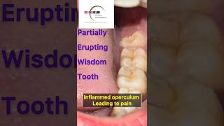 Is your wisdom tooth causing PAIN Watch this before getting it removed teethpain dentist [upl. by Adara]