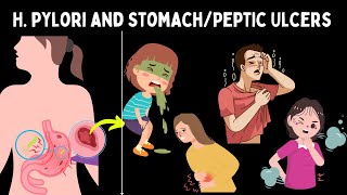 H pylori Causes of stomachPeptic Ulcer symptoms diagnosis treatment in Hindi🤔 [upl. by Menken]