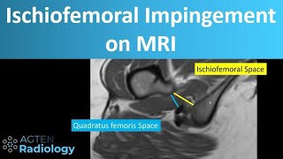 Ischiofemoral impingement on MRI [upl. by Auoz]