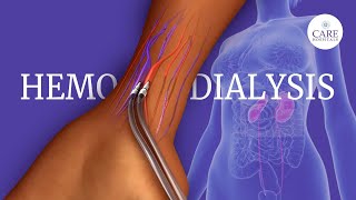 What is Hemodialysis  How is Hemodialysis Done [upl. by Nalloh]