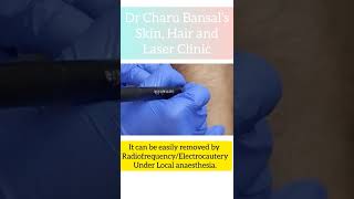 Wart removal treatment of wartverruca by RadiofrequencyElectrocautery DermatologistSkin doctor [upl. by Ashil847]