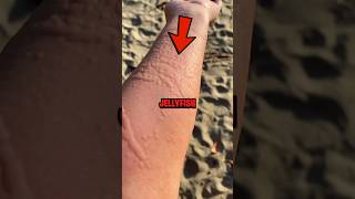 How To Survive a Jellyfish Sting 😨 [upl. by Lower]