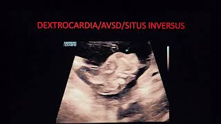 16 week complex cardiac anomalySitus inversusdextrocardiapartial AVSDTG Dr Pradeep srinivasan [upl. by Mariand]