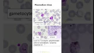 Exam slidesCharts in Pathology Plasmodium vivax Dr GSS SRM MCH RC [upl. by Retsel]