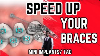 Mini ImplantsBraces ImplantAdvanced Braces technique to move teethTAD [upl. by Arted]