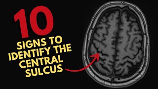 How to find the central sulcus on MRI [upl. by Asiil]