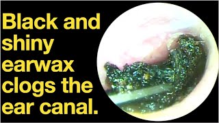 Black and shiny earwax clogs the ear canalear wax removal  ear cleaning  ASMR  relaxation [upl. by Harriot]