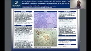 Medullary Thyroid Carcinoma Associated with a Rare RET ProtoOncogene Mutation pK666N [upl. by Gare]