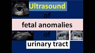 Ultrasound of fetal anomalies of urinary tract [upl. by Oirom59]