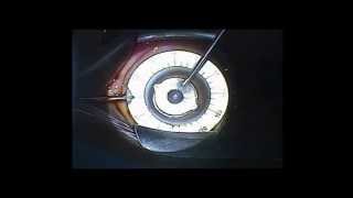 Dr Riad Fikry  Intrastromal Corneal Ring Segments  Manual Insertion [upl. by Sabelle810]