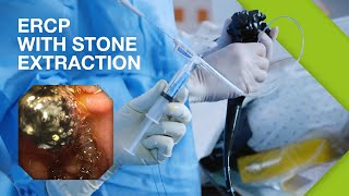 ERCP Practical Guide I Part 2 ERCP with Stone Extraction [upl. by Milde928]