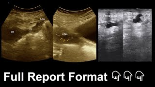 Soft tissue infection  Bilateral hydrosalpinx  Ultrasound  Report  Amader hospital [upl. by Oremor87]