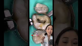 Building a tooth back up after cavity removal cavity dentistry filling [upl. by Chancelor]