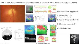 Lecture Using OCT as an Approach to Diagnose Glaucomatous and Other Optic Neuropathies [upl. by Kepner]