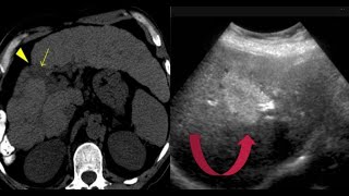 liver Spotters Radiology cases 15 case in 15 minutes radiopedia medicalimaging frcr [upl. by Ocinemod]