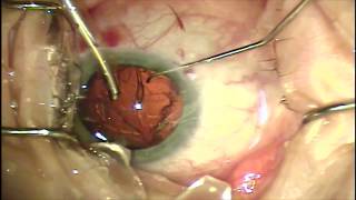 Toric IOL implantation with intraoperative surprise [upl. by Menashem]