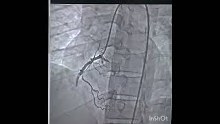 PRIMARY PCI TO RCA GRADE V THROMBUS [upl. by Peursem548]