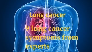 9 lung cancer symptoms from experts [upl. by Benil]