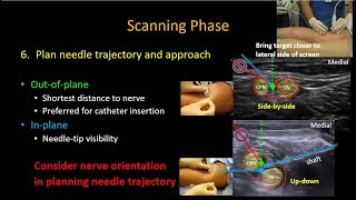 USguided Popliteal Sciatic Nerve Block [upl. by Corell]