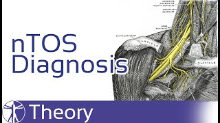 Neurogenic Thoracic Outlet Syndrome Diagnosis  nTOS [upl. by Hoi637]