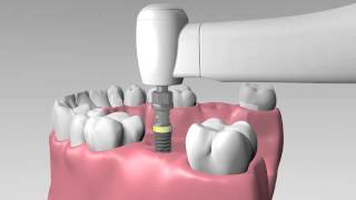 AIDI Biomedical  Implant Pack Placement Procedure [upl. by Angelico]