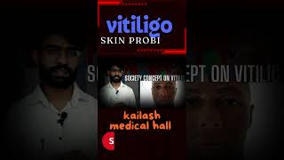 Vitiligo fact Nepali 2024 [upl. by Floro660]