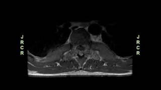 Cord Compression due to Extramedullary Hematopoiesis in an Adolescent with Beta Thalassemia Major [upl. by Adnohsed]