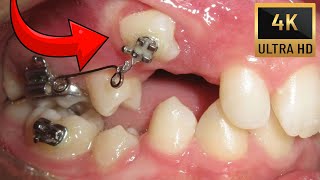 🔥Unexpected orthodontic impaction🔥Timelapse of BRACES in 4K [upl. by Gelb]