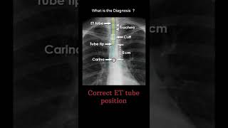 Correct ET endotracheal  tube position 172 chest Xray tubes Quiz radiologychannel007 [upl. by Oicnerolf]