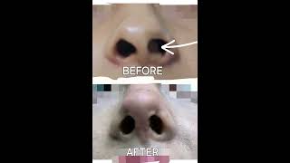 What is a Deviated Nasal Septum facequation nepalidoctor septoplasty rhinoplasty [upl. by Mireielle]