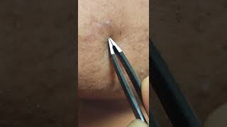 Satisfying Facial Hair Extraction Stubborn Hair Plucking And Tweezing [upl. by Reivilo959]