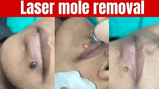 Laser mole removal Mole removal in Ranchi Best way to remove mole scarmoleremoval [upl. by Powell694]