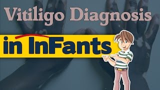 Vitiligo Diagnosis in Infants [upl. by Aramal]