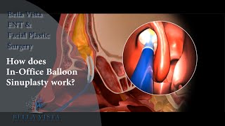 Sinus Procedure InOffice  Balloon Sinuplasty [upl. by Kussell]