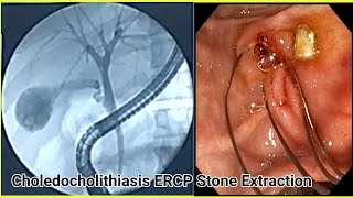 ERCP Stone Extraction BDENDOSCOPY [upl. by Tony]