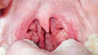 Tonsil Stones Removal from Deep Tonsil Crepts [upl. by Annoek]