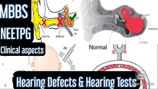 Hearing Defects amp Hearing Tests Rinnes test Webers test Schwabachs test mbbs neetpg [upl. by Yahs]