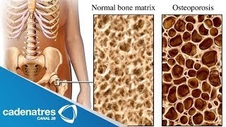 ¿Qué es la Osteoporosis  Cómo prevenir la osteoporosis [upl. by Orsini]