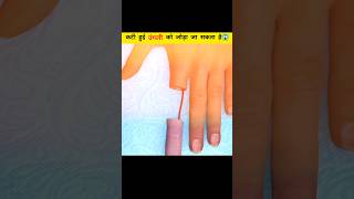 Finger can be reattached after being amputated [upl. by Licko]